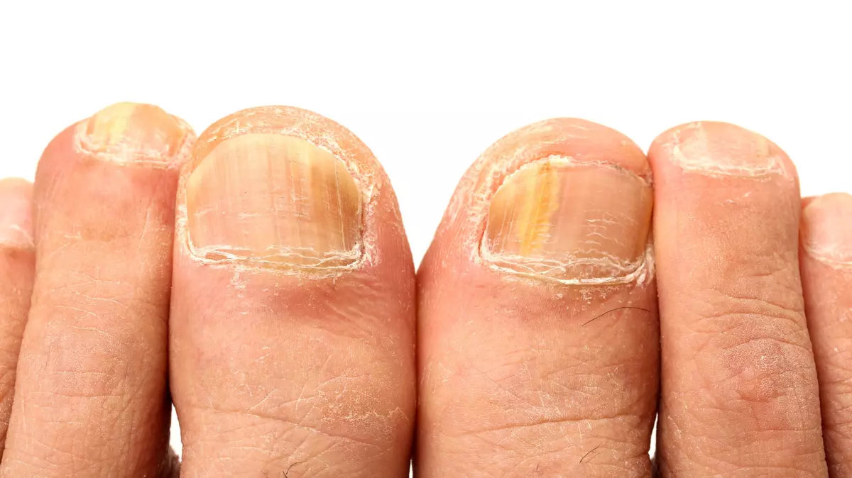 Wie Erkennt Man Einen Nagelpilz www.ptaheute.de